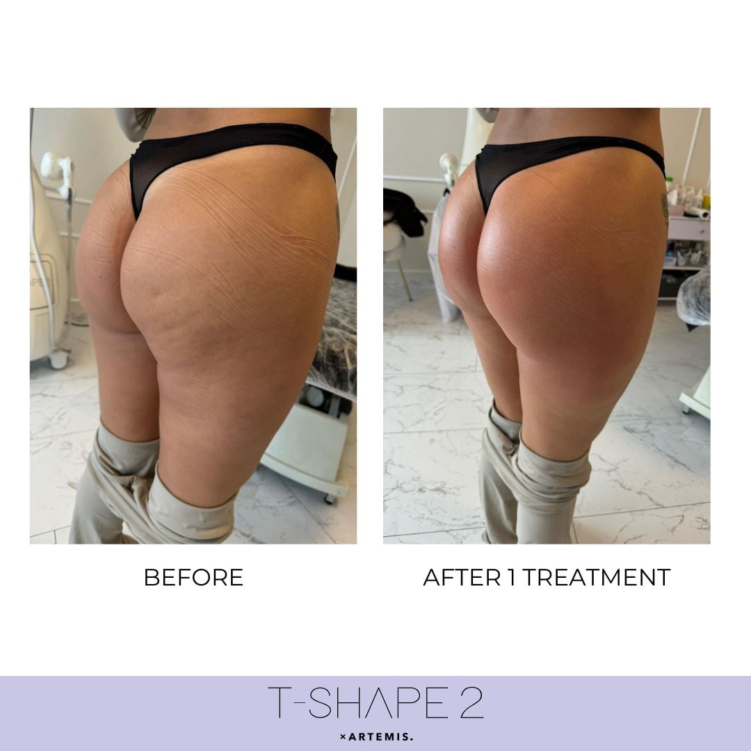 t-shape before and after for cellulite reduction in butt body sculpting