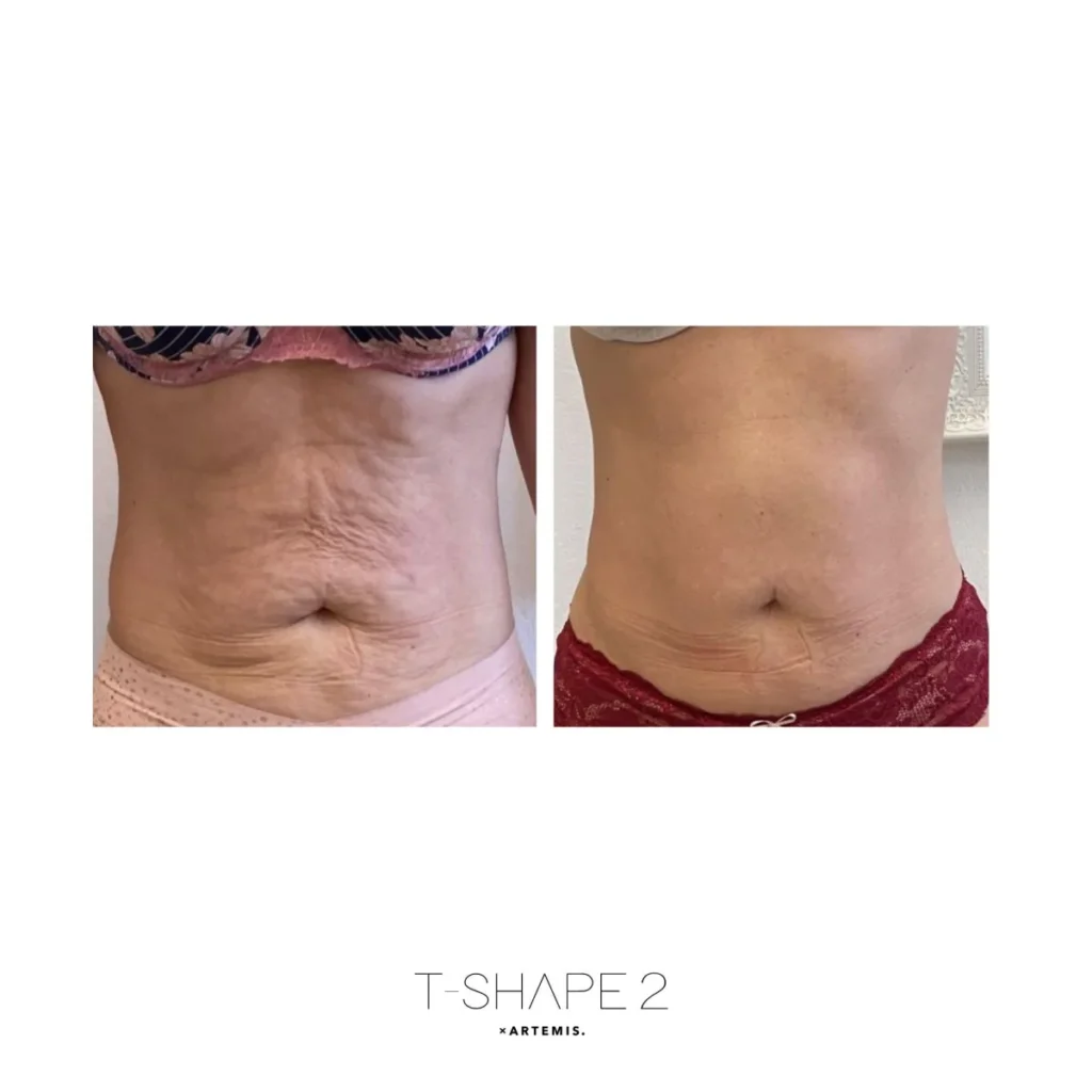 before and after non-surgical cellulite treatment in tuscon az