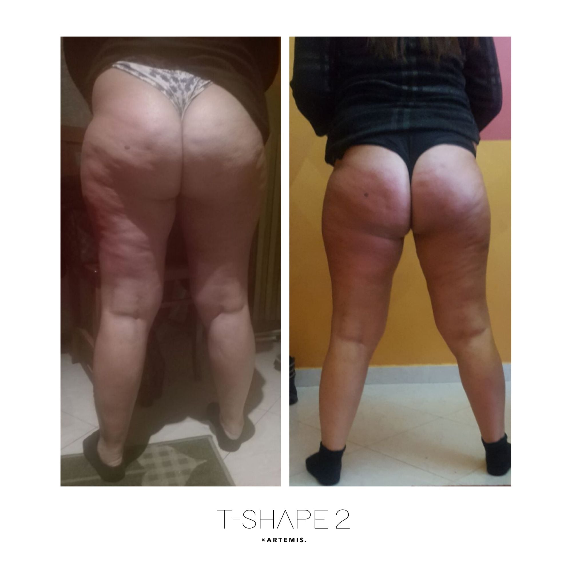 t-shape before and after for fat and cellulite reduction body sculpting