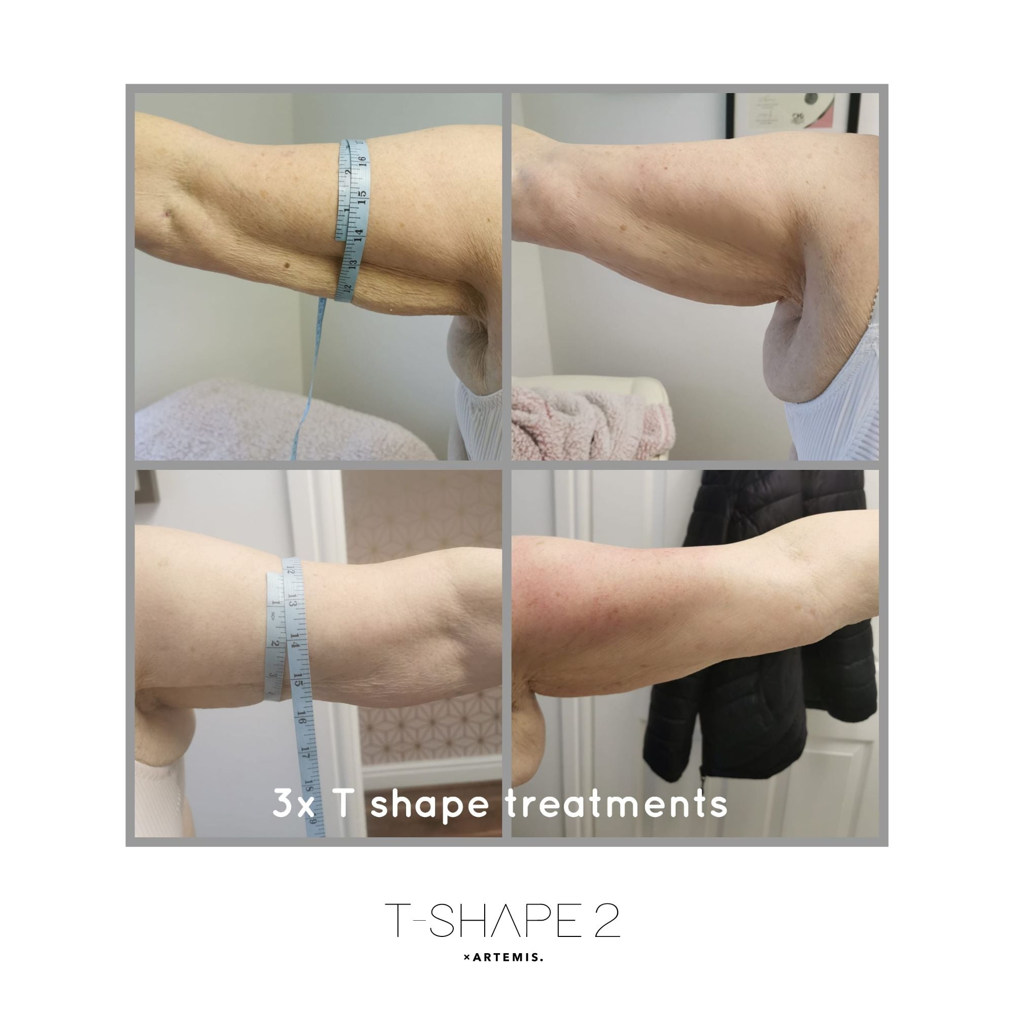 arm skin tightening with t-shape in Tucson