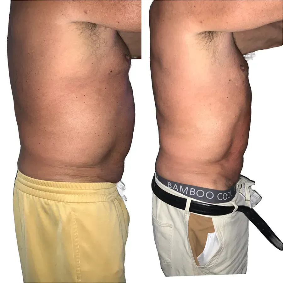 mens stomach before and after weight loss no shots no injections non-surgical