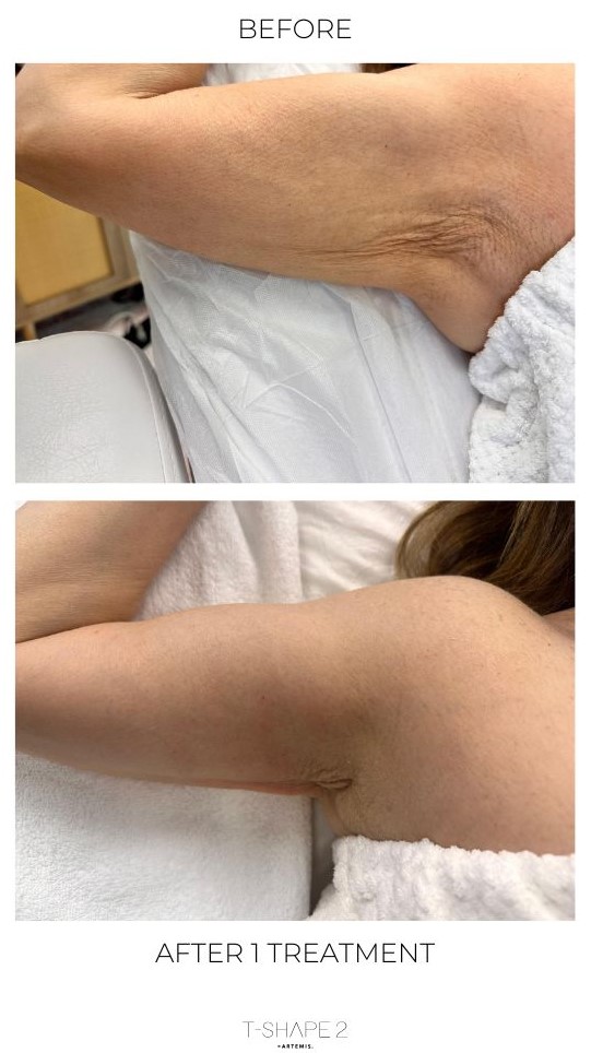 before and after of loose arm skin tightening
