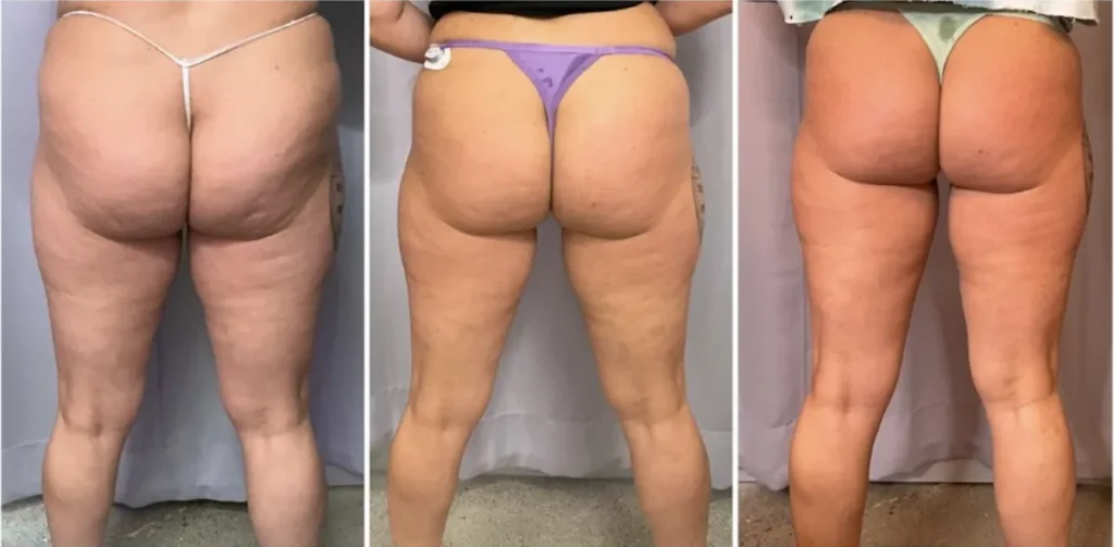 before and after of butt body contouring