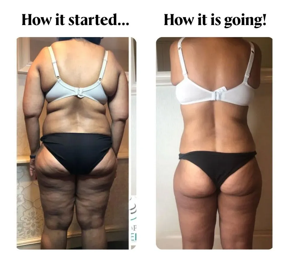 T Shape 2 Body Contouring & Skin Tightening Services in Tucson