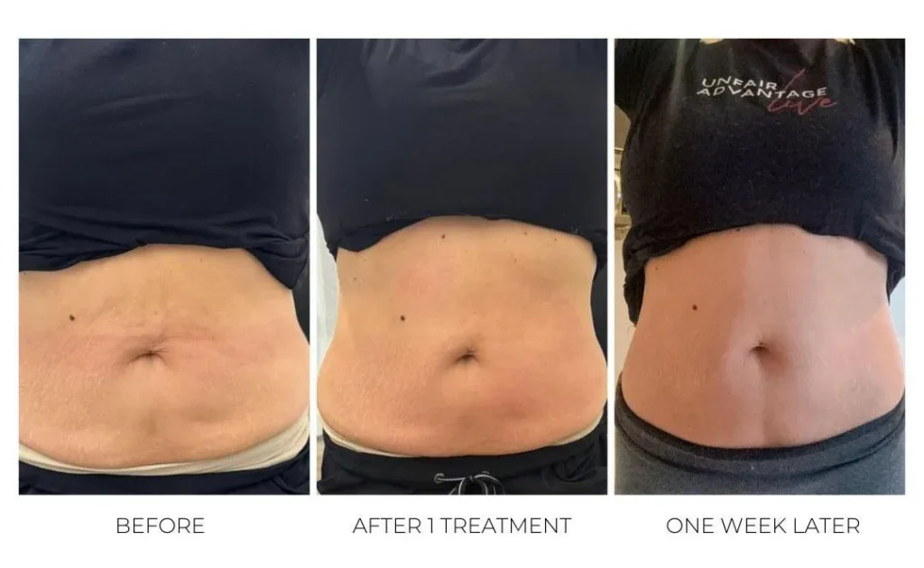 Stomach Skin Tightening with T-Shape